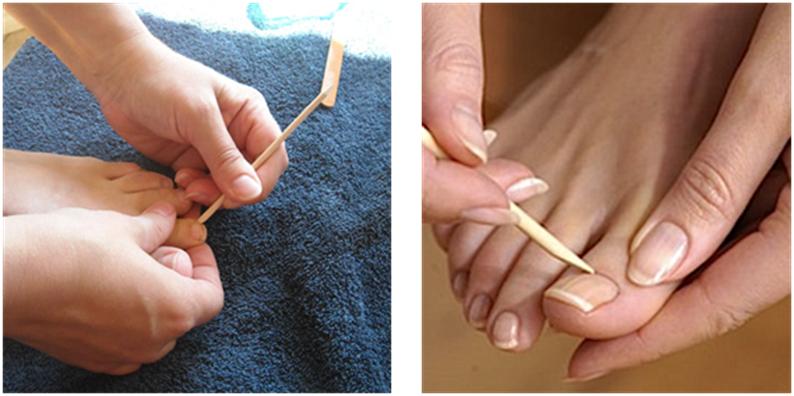 Repousser les cuticules des ongles de pieds